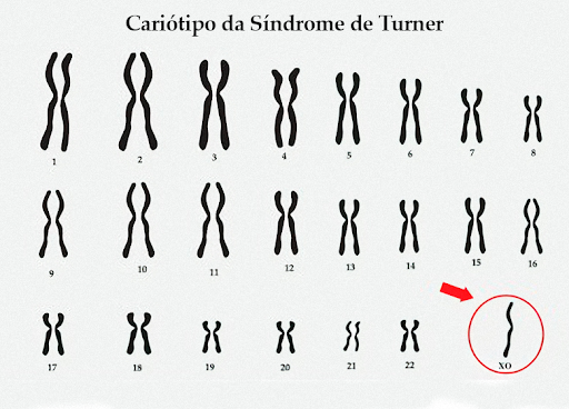 alterações cromossômicas - cariótipo da síndrome de turner