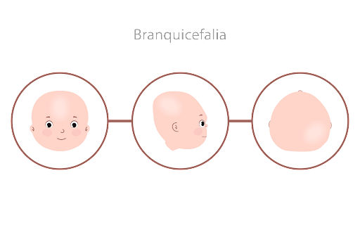 assimetria craniana - braquicefalia
