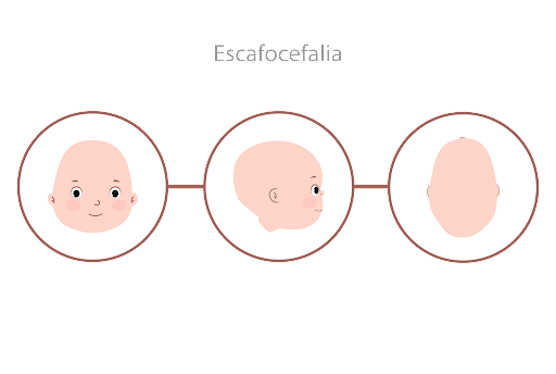 assimetria craniana - escafocefalia