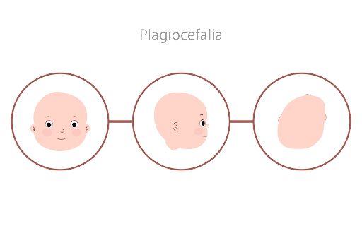 assimetria craniana - plagiocefalia